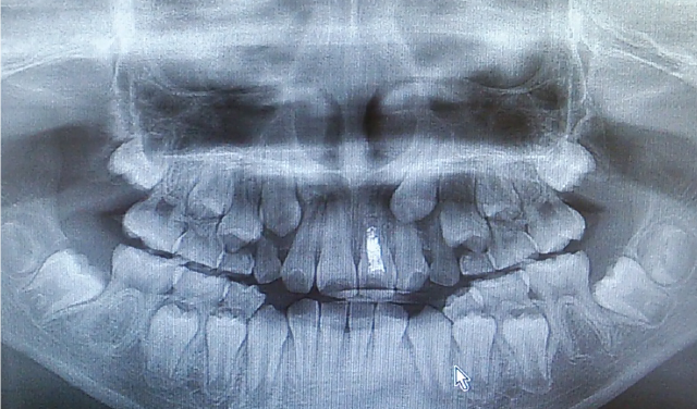 歯科矯正のレントゲン
